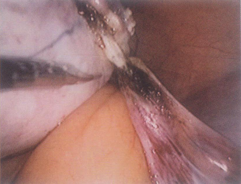 第10章 腹腔镜输卵管卵巢切除术